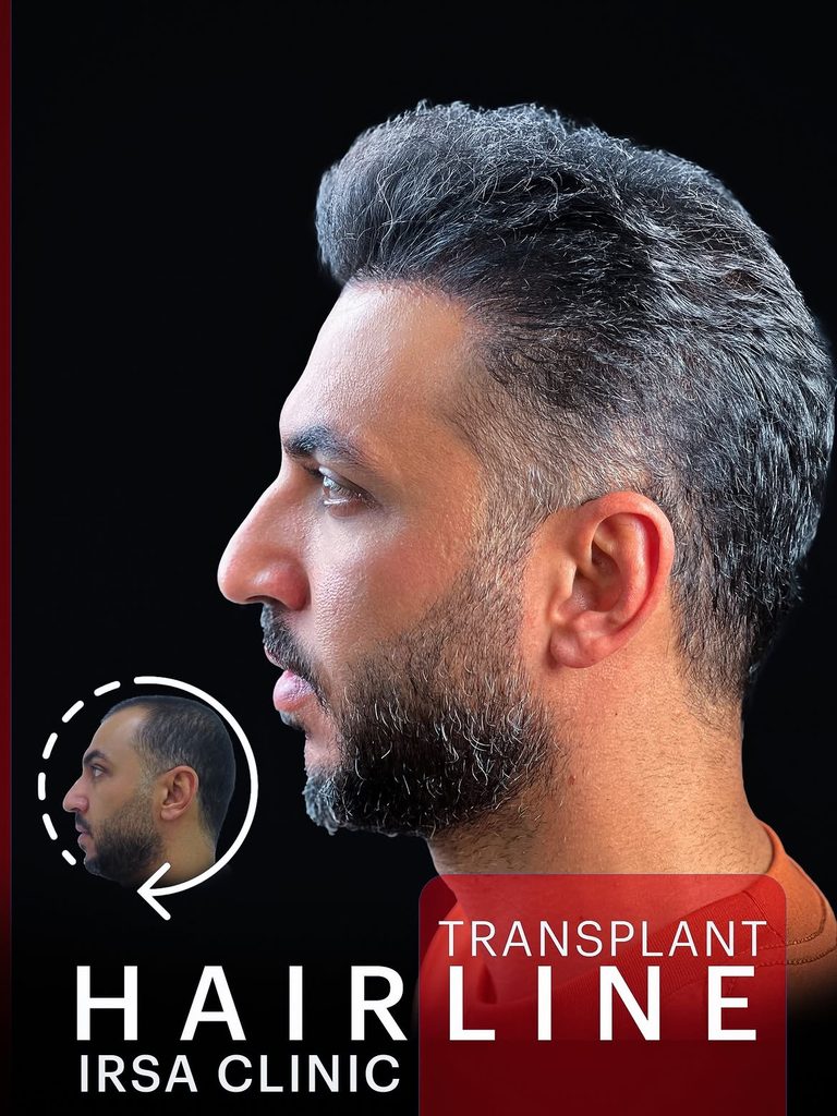 نمونه کار قبل وبعد کاشت مو در کلینیک ایرسا در شیراز از همه زوایا