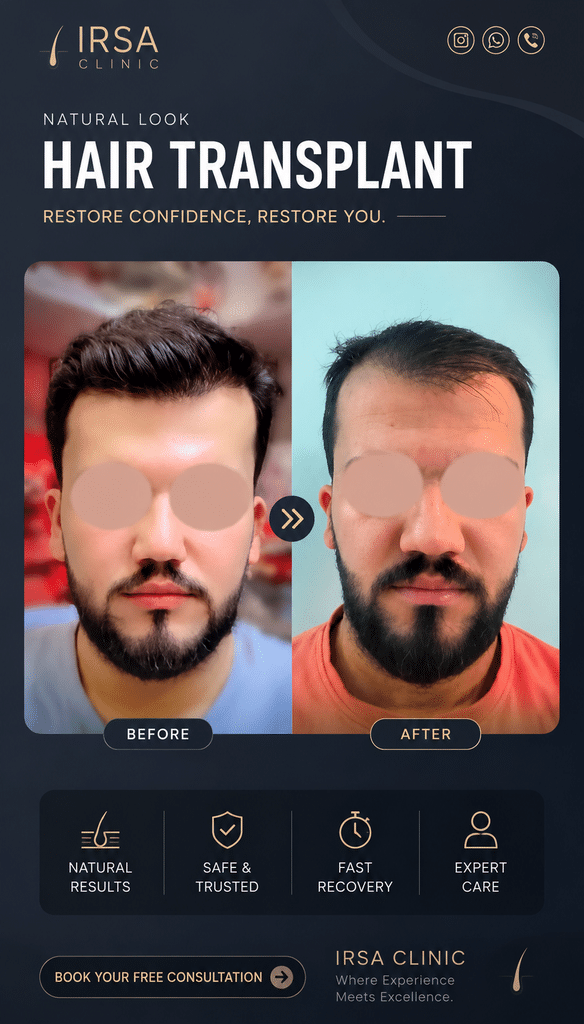 نمونه کار قبل وبعد کاشت مو در کلینیک ایرسا در شیراز