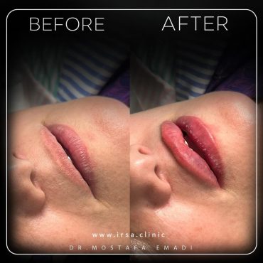 lip-filler-injection-in-Iran-01
