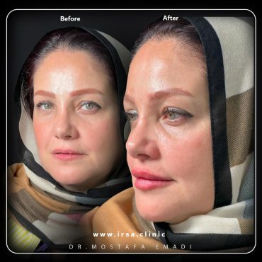 lip-filler-injection-in-Iran-03